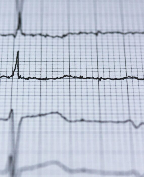 Abnormal EKG readout symbolizing slowed heart rate risk from medetomidine in street drugs
