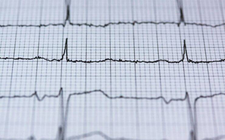 Abnormal EKG readout symbolizing slowed heart rate risk from medetomidine in street drugs